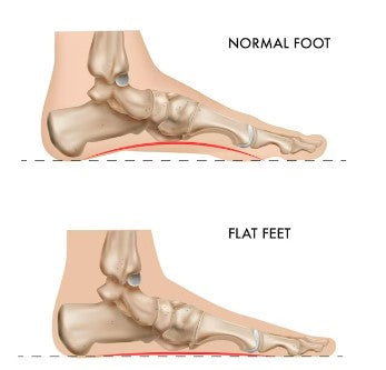 Disadvantages of having flat feet